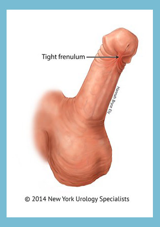 Penis frenectomy perth